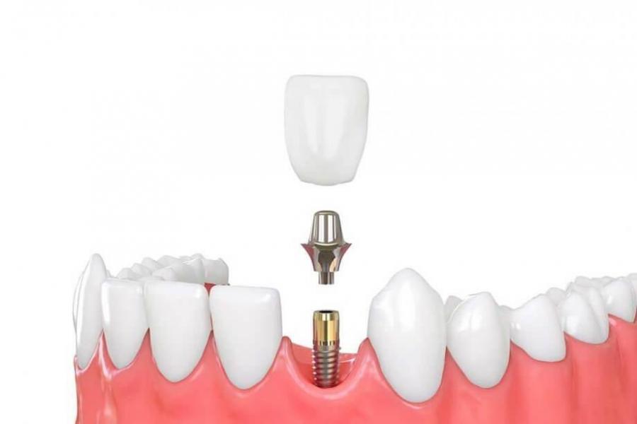 Dental Implant and Crown: Is This Combination Right for You?